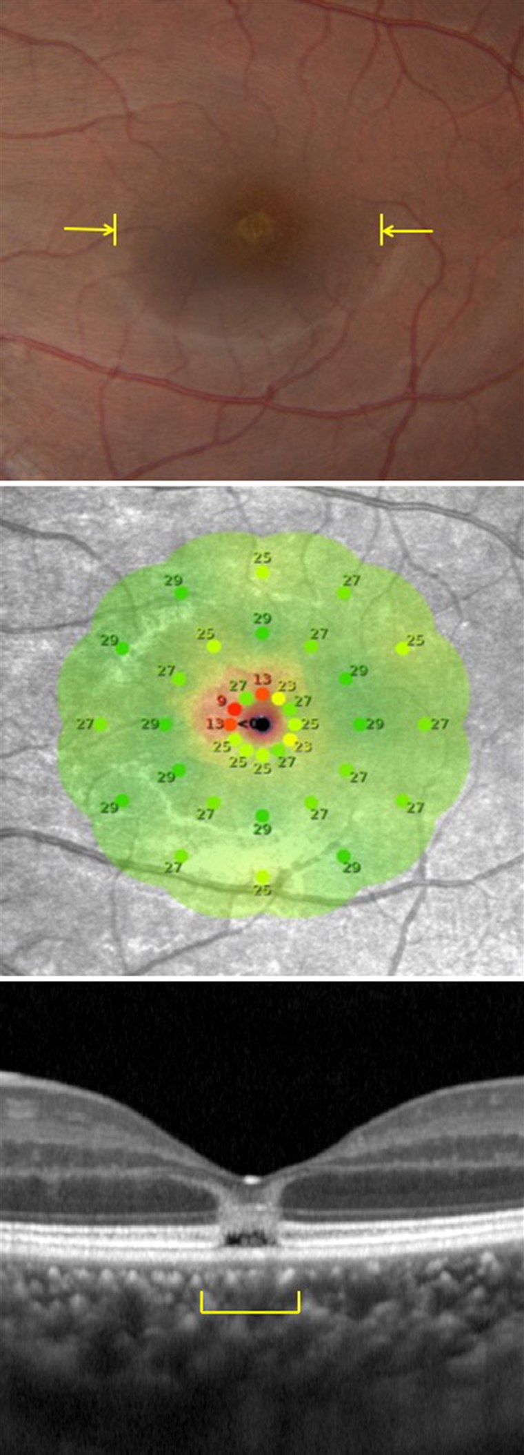 الجديد technology allowed doctors to see for the first time what happens when someone experiences solar retinopathy. 
