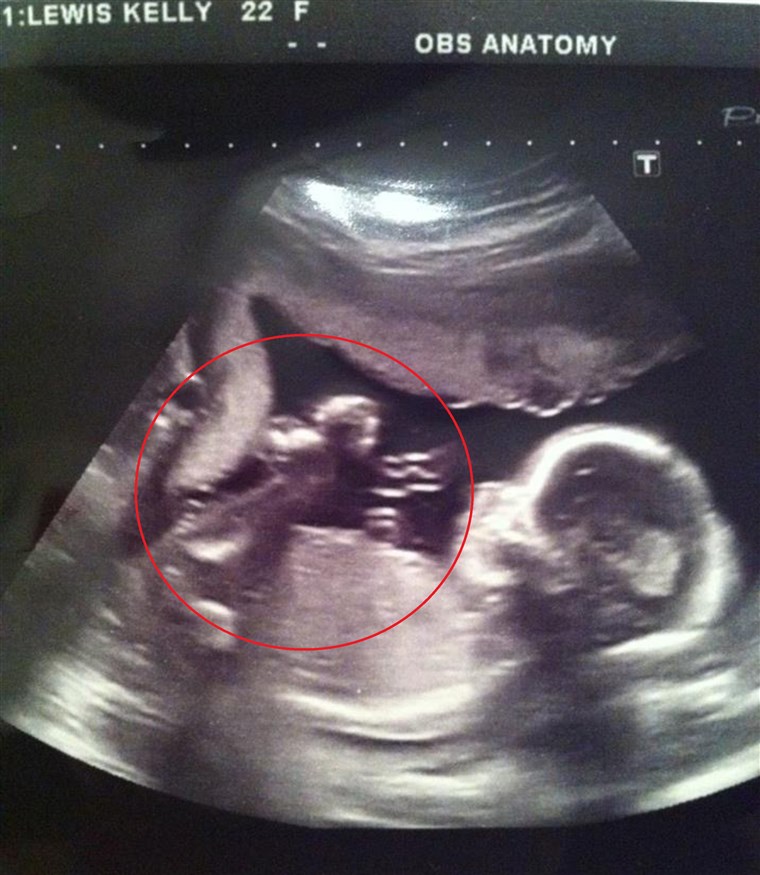 Lewis' ultrasound