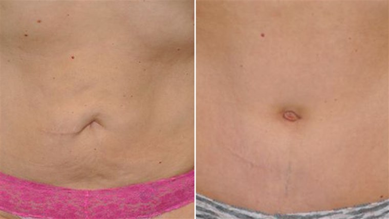 Vor and after belly button surgery