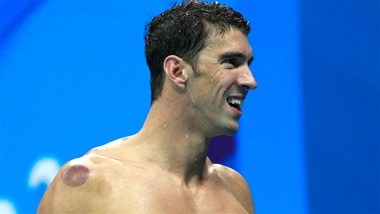 迈克尔 Phelps cupping