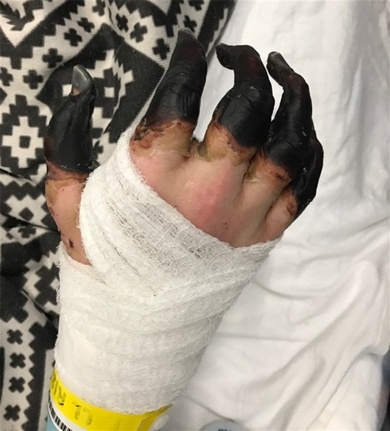 布林's hands turned black as a result of his infection and may have to be amputated. 