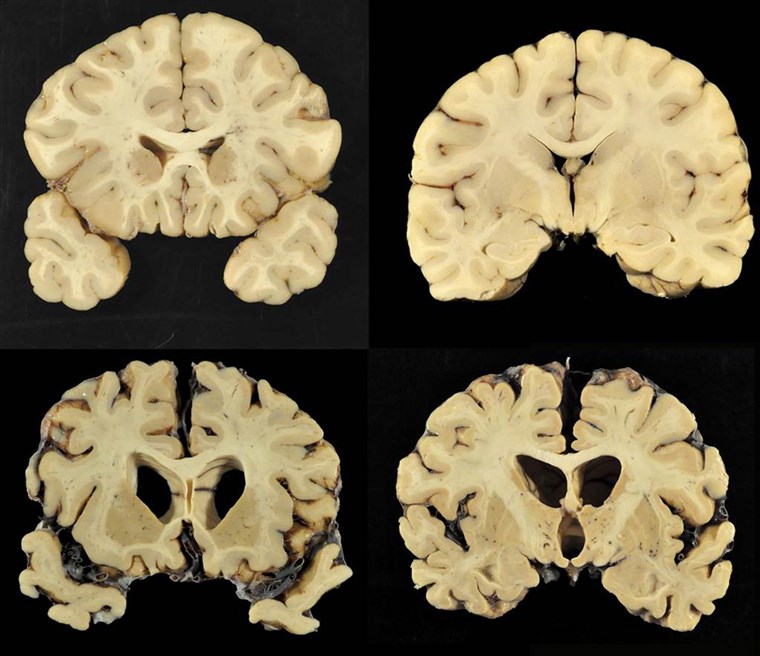 Abschnitte from a normal brain, top, and from the brain of former University of Texas football player Greg Ploetz, bottom, in stage IV of chronic traumatic encephalopathy. 