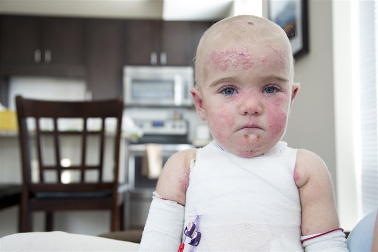 17 měsíců stará Elisa McCann is living with Epidermolysis Bullosa, a rare and debilitating skin disease. Her condition has been rapidly improving after s...