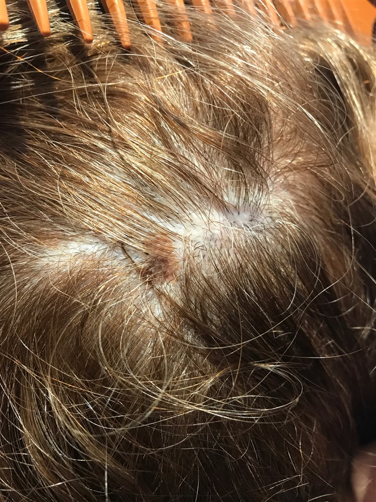 Když Eileen Korey was getting her hair colored, her stylist, Kari Phillips noticed a new spot on Korey's head. She took a picture, which encouraged Korey to see her doctor, when Korey learned it was melanoma.