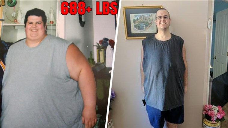 След losing 374 pounds, Sal Paradiso has about 80 pounds of excess skin that needs to be removed. 